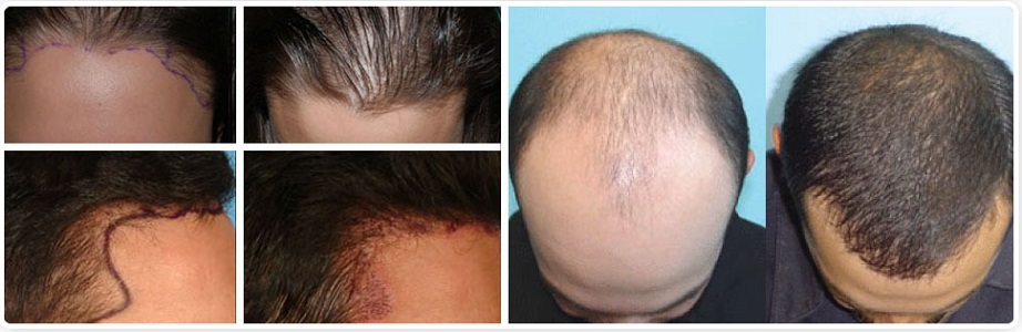 Hair Transplant