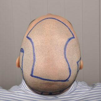 Hair Transplant