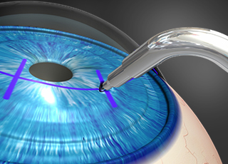 Eye Surgery and Disease and Corneal Transplant