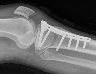 Orthopedic Surgery and Replacement of Joints and Fractures